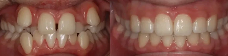 before-after-braces
