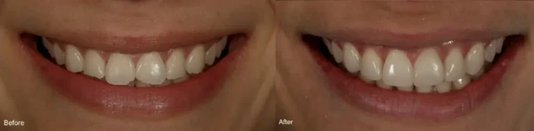 before-after-chipped