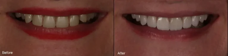 before-after-whitening