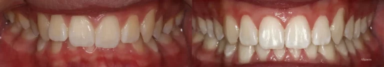 Aligners