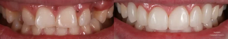 Composite Veneers