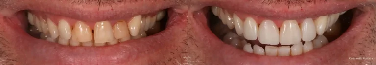 Composite Veneers
