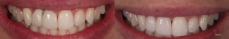 Implant