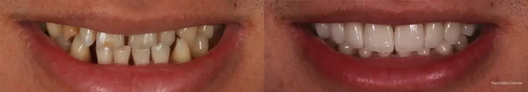 Porcelain Crowns