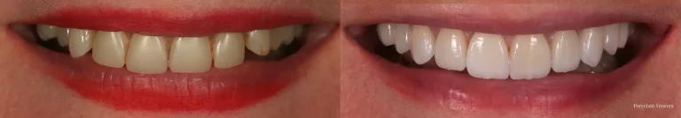 Porcelain Veneers
