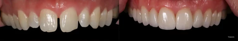 Veneers